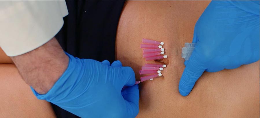 Physician inserting multiple Smooth PDO Thread’s into patient’s abdomen in pattern to tighten area