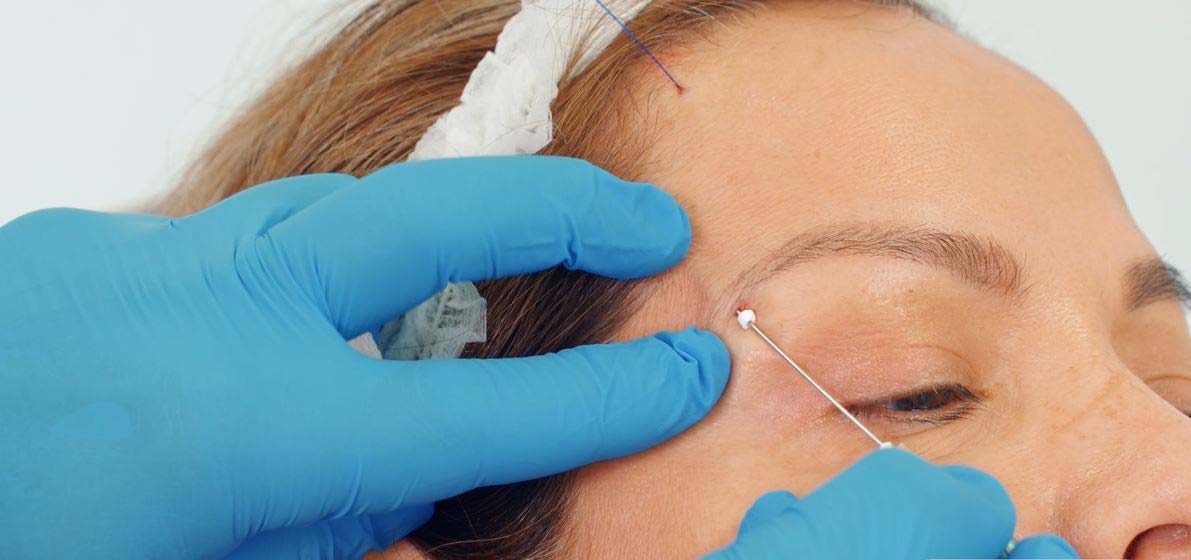 Physician performing Barbed PDO Thread lift just below patient’s eyebrow to accomplish brow lift