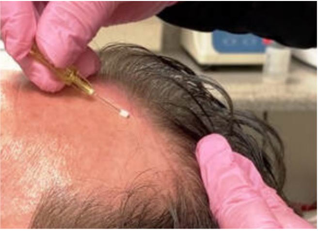 Photo detailing depth of PDO Thread inserted in forehead