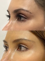 Before and after of patient's face who received Cat Eye Lift procedure with PDO Threads