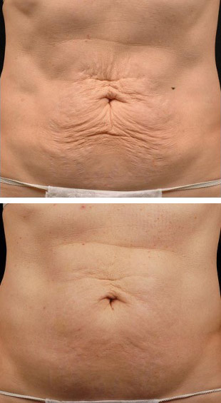 Before and after of patient who received PDO Threads in abdomen region to lift and contour area