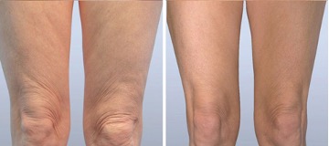 Before and after of patient who received PDO Threads in legs to contour and boost collagen