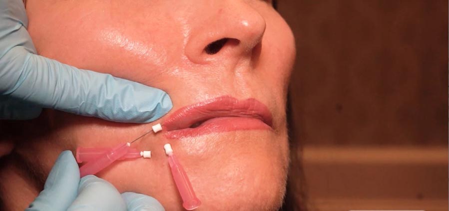 Physician executing a chin lift and collagen boost of lips using multiple Smooth PDO Threads