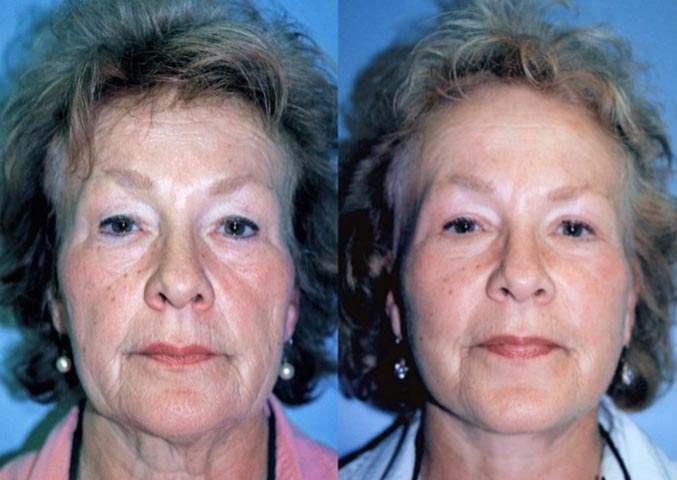 Before and after of patient’s face after PDO Threads and collagen biostimulators to boost collagen