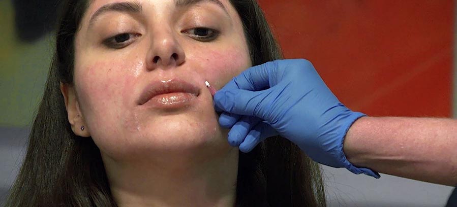 Physician performing Smooth PDO Thread Lift above top lip of patient to improve collagen production