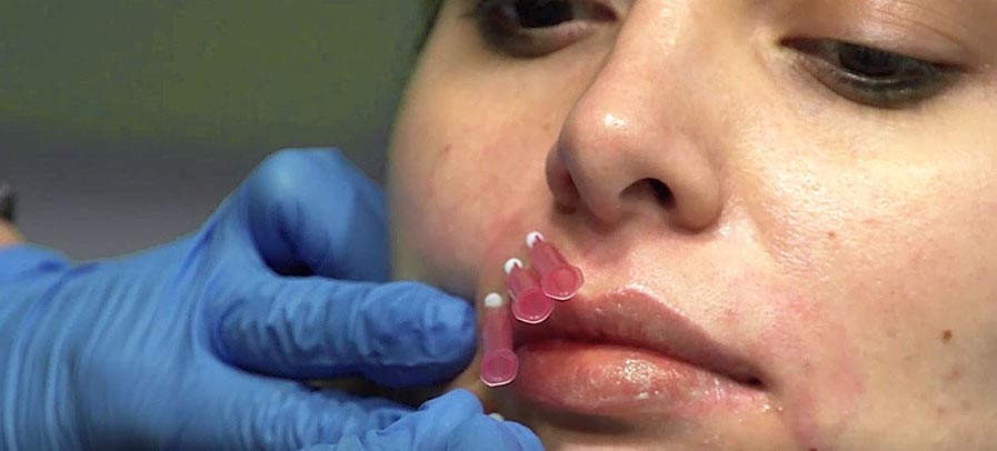 Physician inserting multiple Smooth PDO Threads above lip of patient to boost collagen production in that area