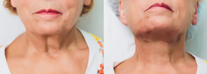 Before and after of patient who received combination treatment with PDO Threads and dermal fillers or PRP