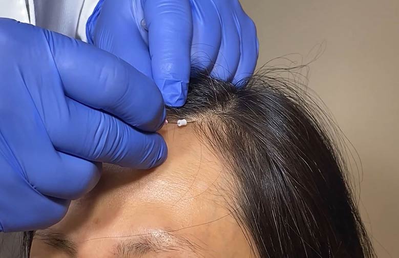 Physician performing Smooth PDO Thread on hairline of patient to restore hair