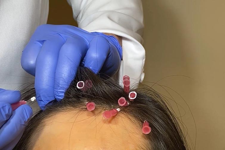 Physician inserting multiple Smooth PDO Threads into hairline of patient in pattern to promote hair restoration