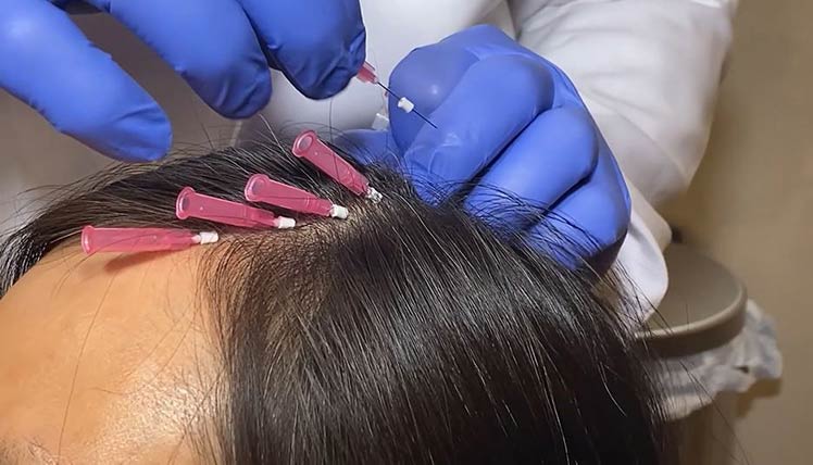 Physician inserting multiple Smooth PDO Threads into hairline of patient in a row to stimulate hair restoration