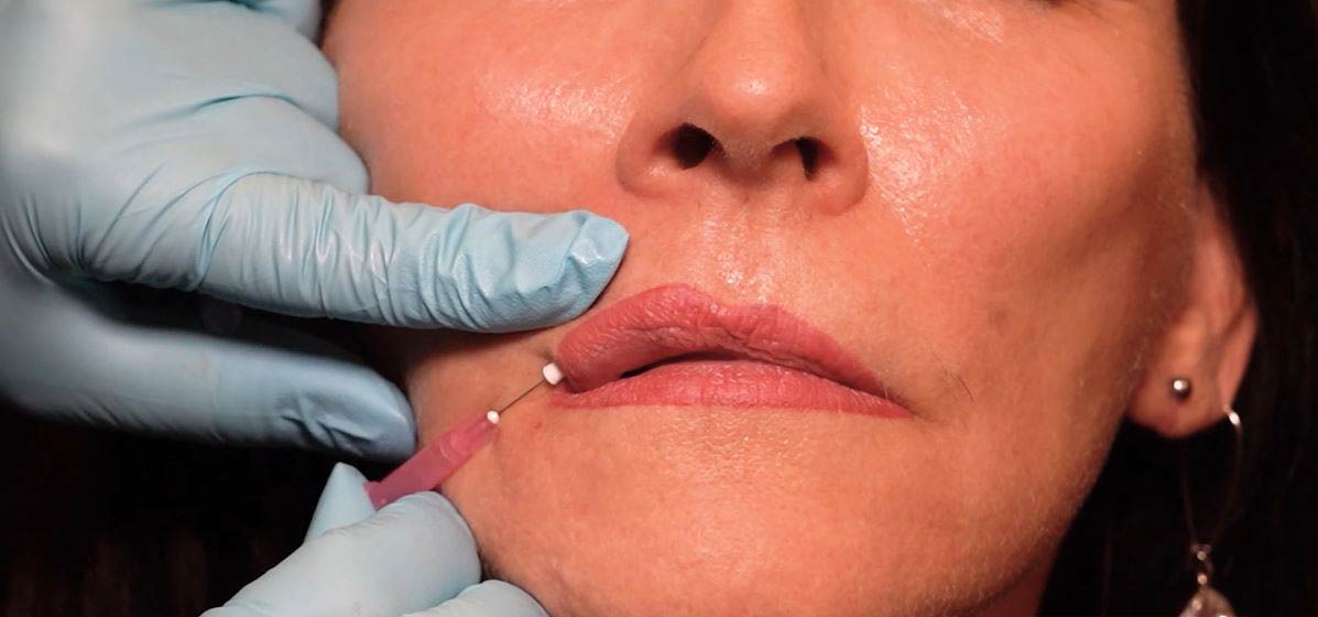 Physician inserting Smooth PDO Thread into lip of patient to increase production of collagen