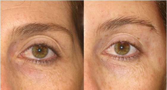 Before and after of patient who received non-surgical Brow Lift using PDO Thread sutures