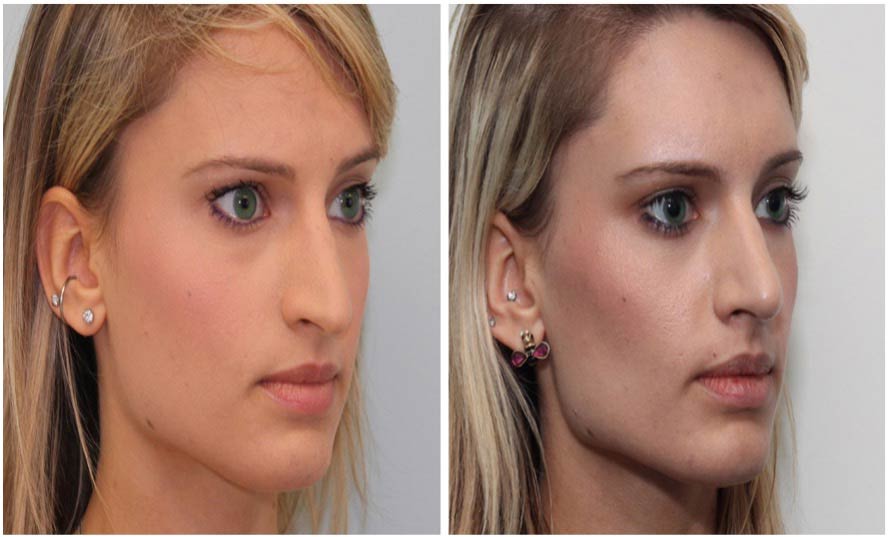 Before and after of patient who received non-surgical Nose treatment using PDO Threads