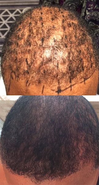 Before and after of patient utilizing combination therapy of PDO Threads and alopecia for hair restoration