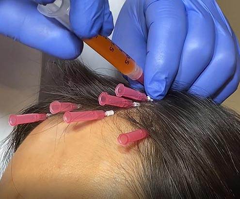 Patient receiving numbing injection in scalp while Twisted PDO Threads sit in scalp to promote hair restoration and boost collagen in area