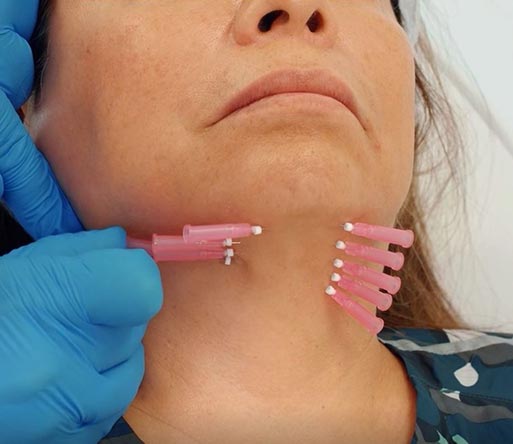 Patient receiving Twisted PDO Threads in mesh pattern under neck to contour and lift area